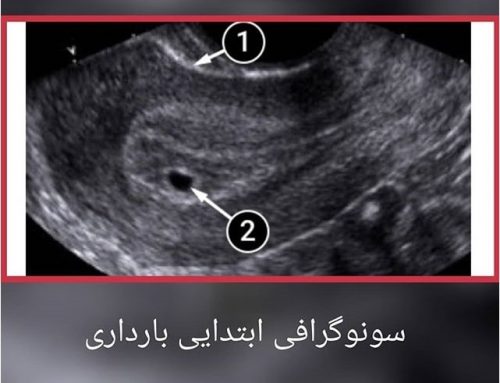 سونوگرافی ابتدای بارداری