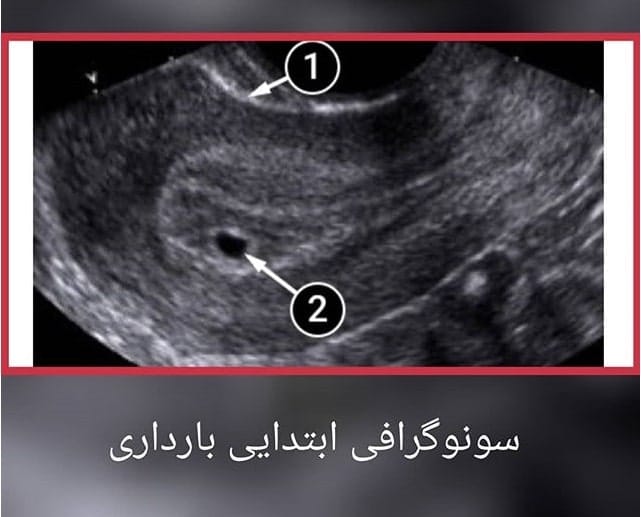 سونوگرافی ابتدایی بارداری